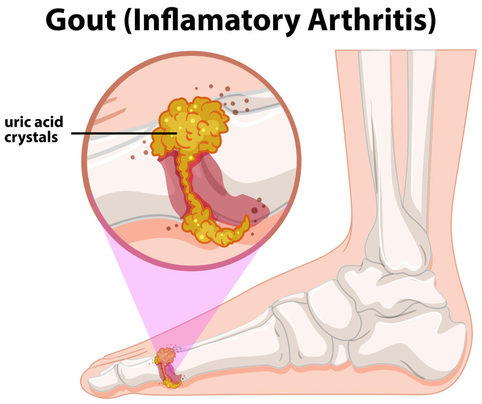 <em>Uric acid – Gout is caused by high levels of uric acid, which can form crystals around the joints (Picture: Getty)</em>