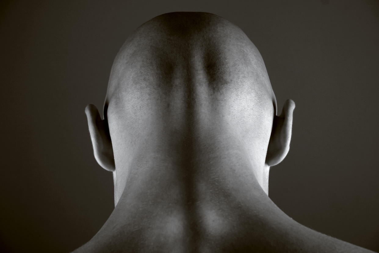 Scientists say they are close to discovering a cure for baldness [Photo: Getty]