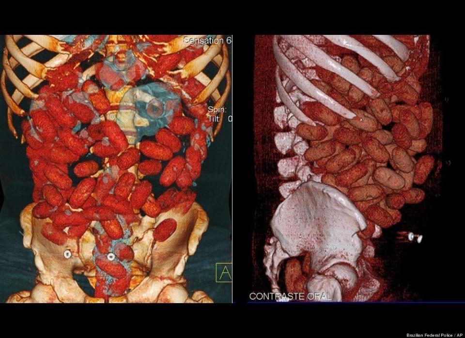  In this Monday Sept. 12, 2011 image of a CAT scan released by Brazilian Federal Police on Sept. 16, 2011, bags loaded with cocaine are seen inside the body of an unidentified man after he was arrested at the Congonhas airport in Sao Paulo, Brazil on Monday. According to a federal police press release, the man is identified as a young Irish male who tried to board a flight to Brussels after swallowing 72 capsules containing a total of 830 grams (1.82 pounds) of cocaine. 