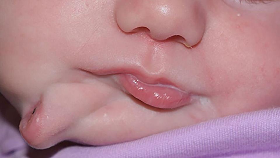 女嬰臉上長出2個嘴巴。（圖/翻攝自《英國醫學期刊》）