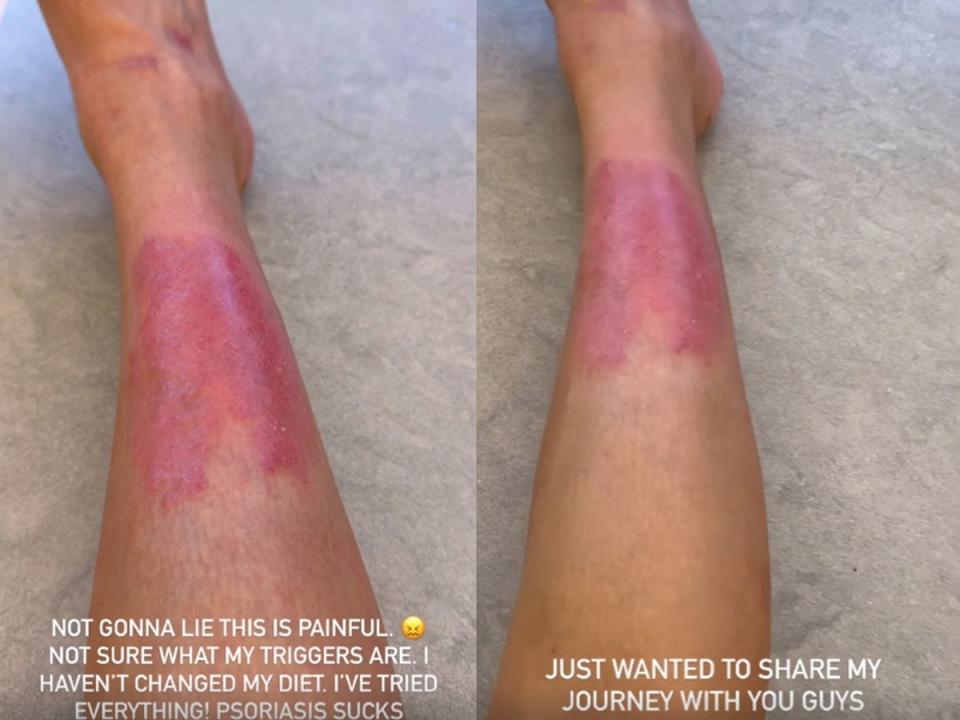 Kim Kardashian shares her psoriasis flareup (Kim Kardashian / Instagram)