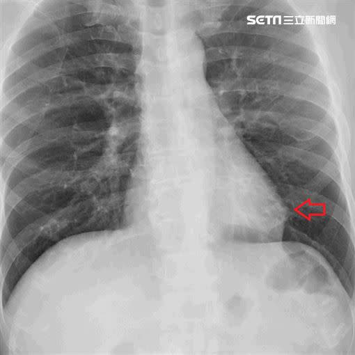 治療後心臟已縮小，兩側肺已無積水情形。（圖／台北慈濟醫院提供）
