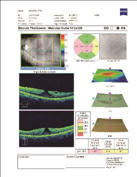 OCT檢查顯示患者左眼板層狀黃斑部有裂孔（lamellar macular hole），箭頭指為裂孔處。