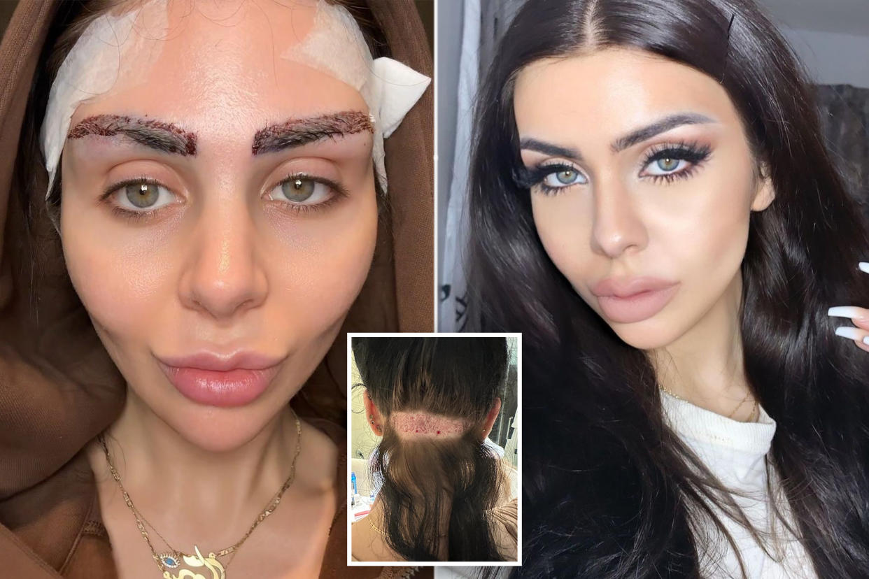A 29-year-old content creator from Los Angeles plunked down about $5,100 for a four-hour eyebrow transplant. She had overplucked her brows as a teen.