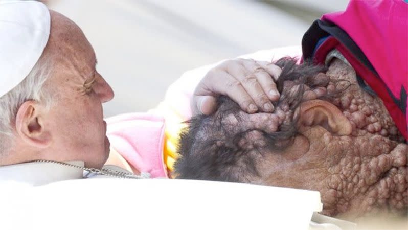 Pope Francis embraces a man with with neurofibromatosis. Photo: ABC.