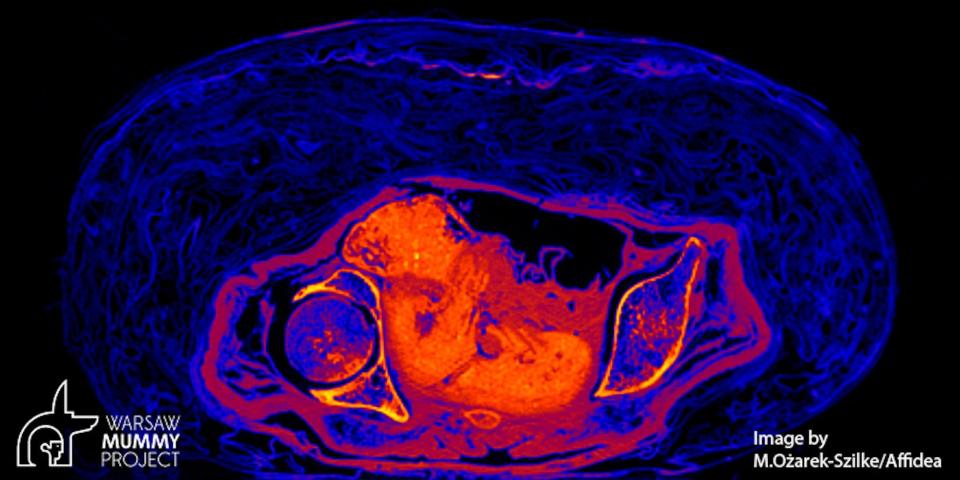 A cross-section of the mummy shows the shape of the dead fetus in the mummy's body.