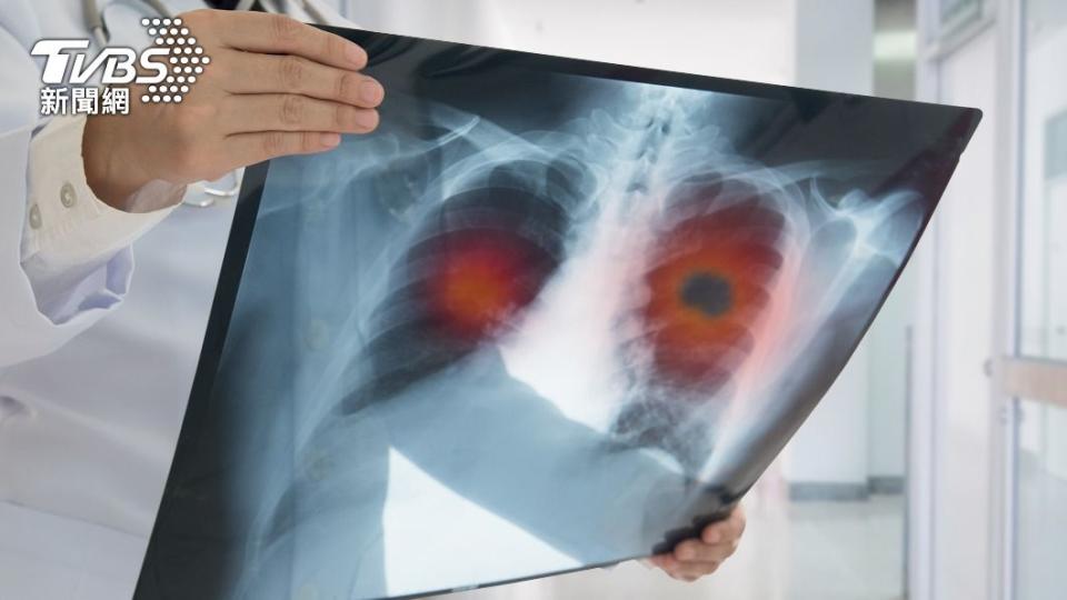 英國科學家針對肺癌患者進行了一項長達9年的追蹤。（示意圖／Shutterstock達志影像）