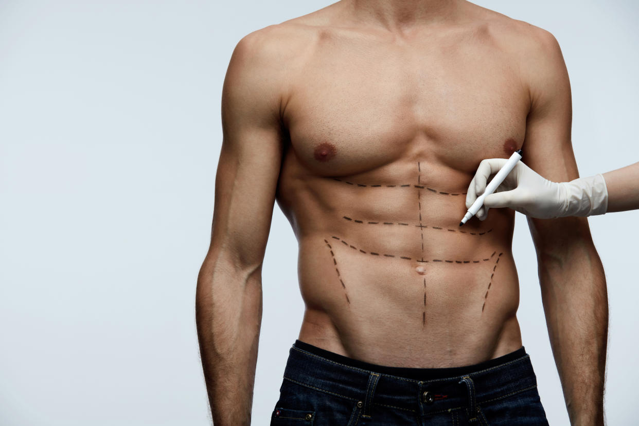 Plastic Surgery. Closeup Of Young Man's Fit Torso With Surgical Lines On His Body Before Beauty Operation. Doctor's Hand In Sterile Glove Drawing Black Marks On Male Patient Body. High Resolution