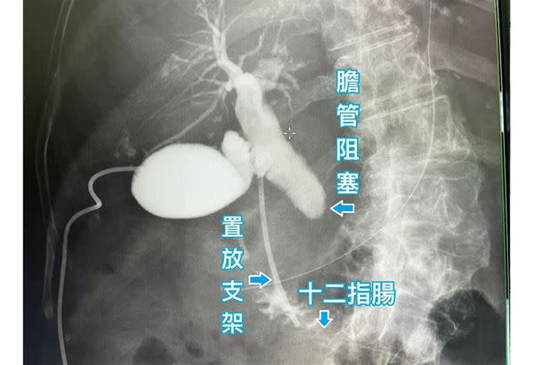 賴阿嬤進行完「膽管十二指腸造口術」後，過了三個月做核磁共振檢查，透過顯影劑可以看到置放支架處依舊暢通，成功解決黃疸的症狀。（圖片提供／烏日林新醫院）