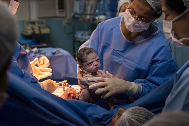 This Baby Basically Delivered Itself During A 'Natural' Cesarean Birth  That's Going Viral