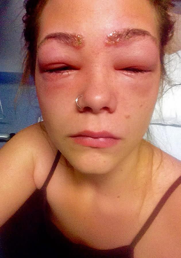 She was left with eyes swollen shut and chemical burns to her eyelids. Photo: Caters News.