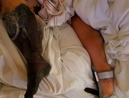 Jonathin’s leg turned black and was eventually amputated. Source: Facebook/Jonathin’s Journey