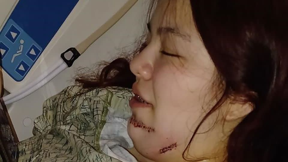 A bullet went through the jaw of Mireya Nelson during the Kansas City Chiefs Super Bowl parade on Feb. 14, 2024. She also has bullet fragments in her shoulder and will need to have her blood tested for lead for at least the next two years. - Erika Nelson