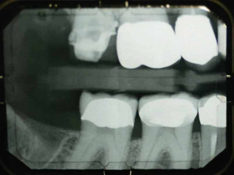 ¿Cuánto tiempo sobreviven los dientes tras una endodoncia?