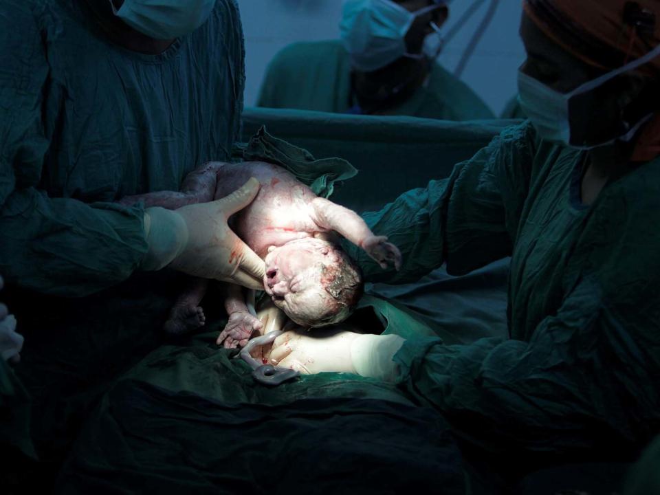 A baby is delivered by caesarean section in Escuela hospital in Honduras, Spain (file photo): REUTERS