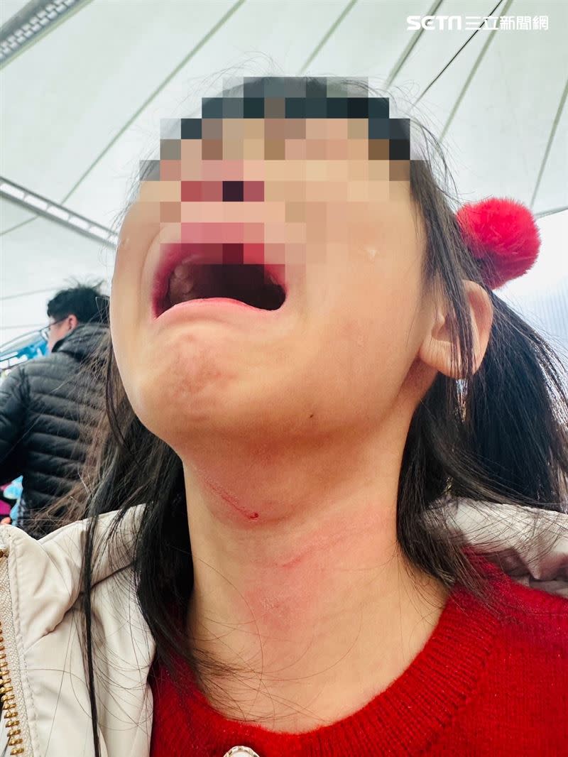 一名家長控訴帶女兒去北市兒童新樂園玩，脖子竟遭安全帽刮傷流血。（圖／投訴家長提供）