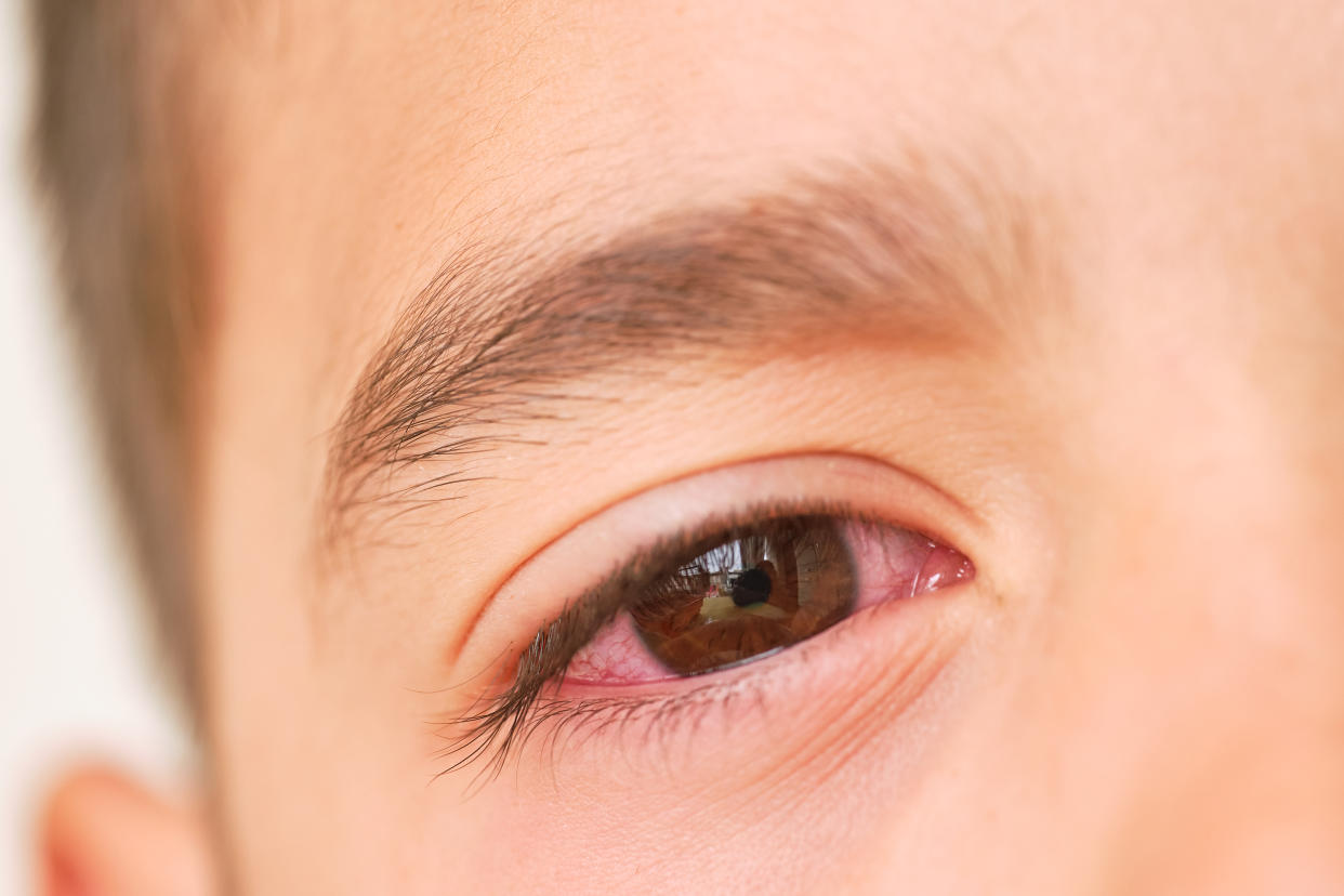 Some doctors say XBB.1.16 may be causing a new symptom among children: conjunctivitis. (Getty Images)