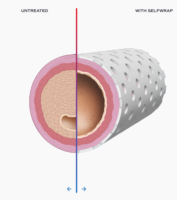 https://storage.googleapis.com/accesswire/media/771019/Untreated-Treated-Cross-section.png