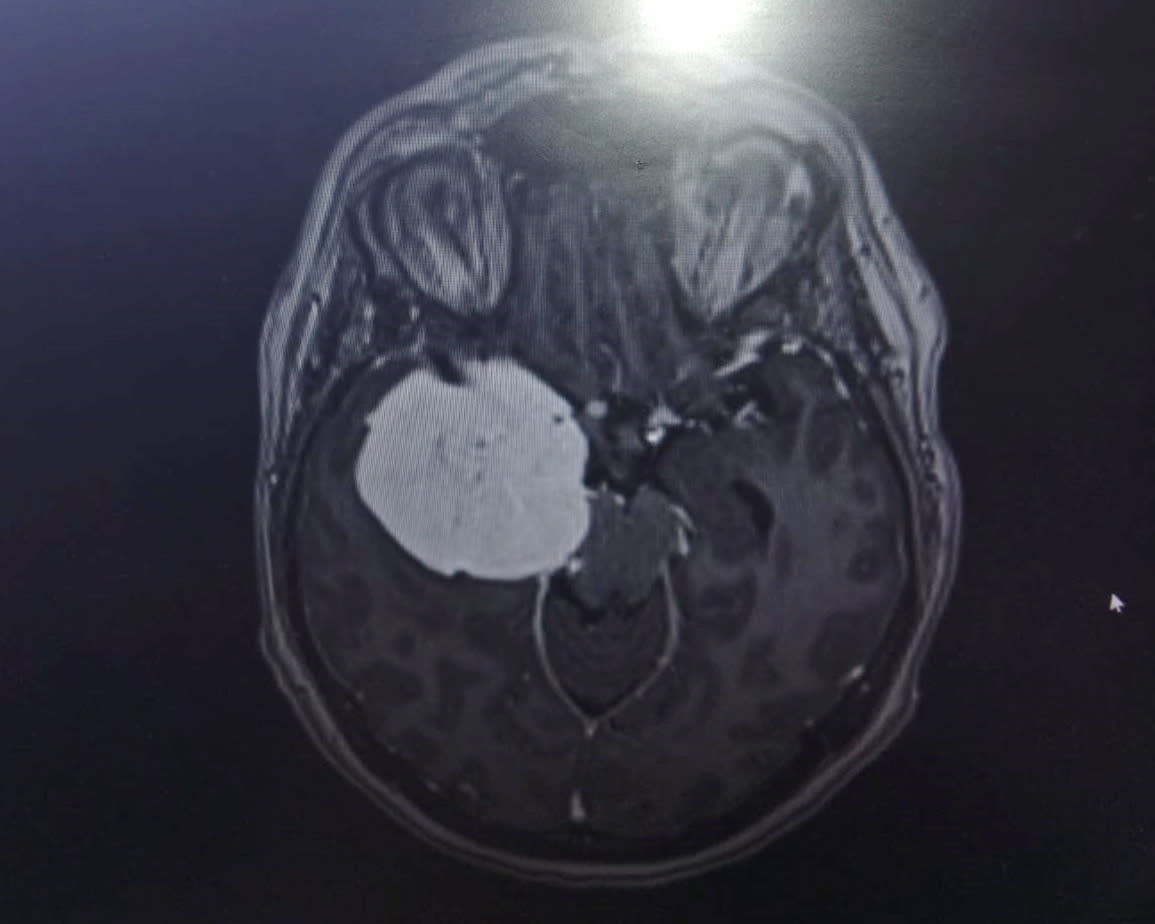 A CT scan revealed Alison had 5cm benign tumour called meningioma. (Alison Haspell/SWNS)