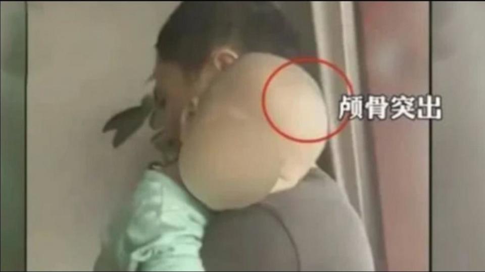 5月時湖南也出現類似案件，許多嬰幼兒出現顱骨發育異常狀況。（圖／翻攝自新京報微博）