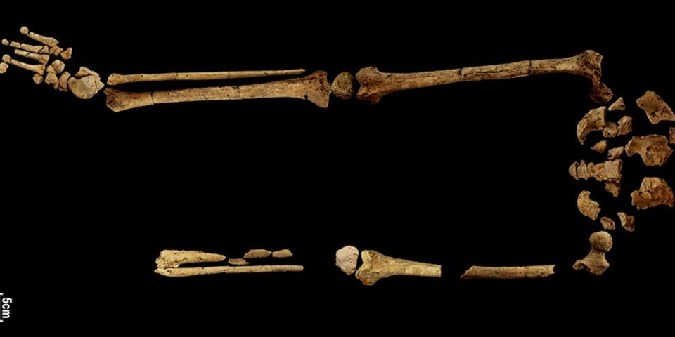 A skeleton who has gone through the world's earliest limb amputation