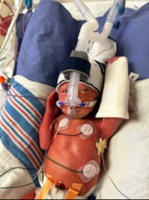 Baby Emilio Torrez pictured during his stay at the NICU following a fetoscopic myelomeningocele spina bifida repair at Children's Hospital Colorado in late summer 2023.