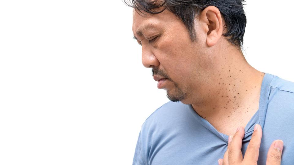 middle age man in blue shirt with skin tags or acrochordon on his neck isolated on white background health care concept