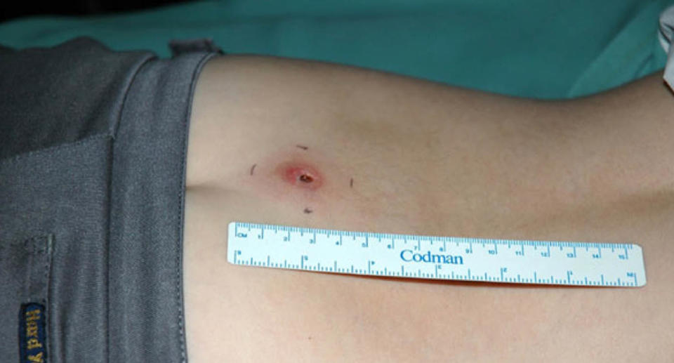 A photo of Buruli ulcer on a boy's lower back. 