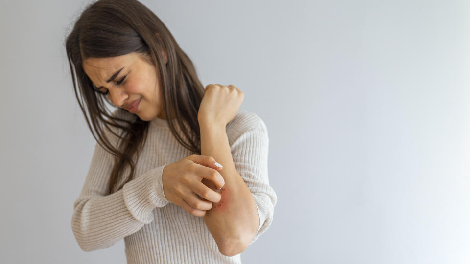 Se manifiesta con lesiones cutáneas de tamaño variable, enrojecidas y recubiertas de escamas blanquecinas de grosor variable que causan picazón, ardor o dolor. (Foto: Getty)