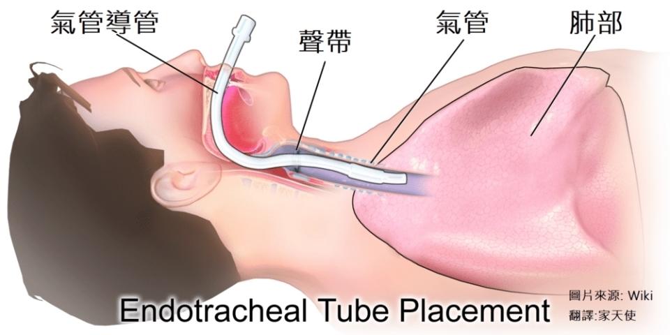 為何要「插管」？又有甚麼併發症？