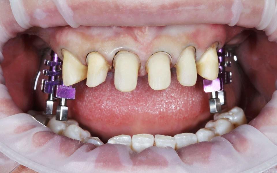 Teeth must be filed down before veneers can be fitted - Valeriia Mitriakova