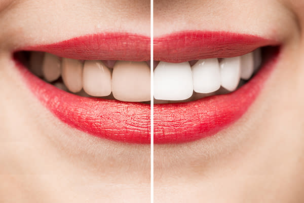 Los dientes blancos serían una característica deseable para empleadores. Foto: turk_stock_photographer / Getty Images.