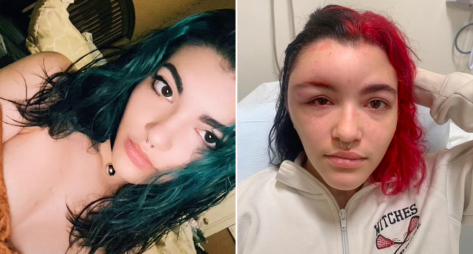 TikTok user @ser.gaya before and after the allergic reaction.