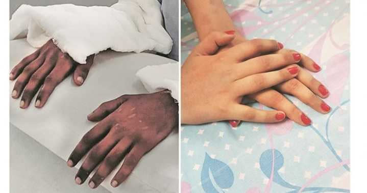 印度女大生在接受跨性別的雙手移植手術後一年，新的手臂膚色「轉性」，變得更加女性化。（圖／翻攝《印度快報》）