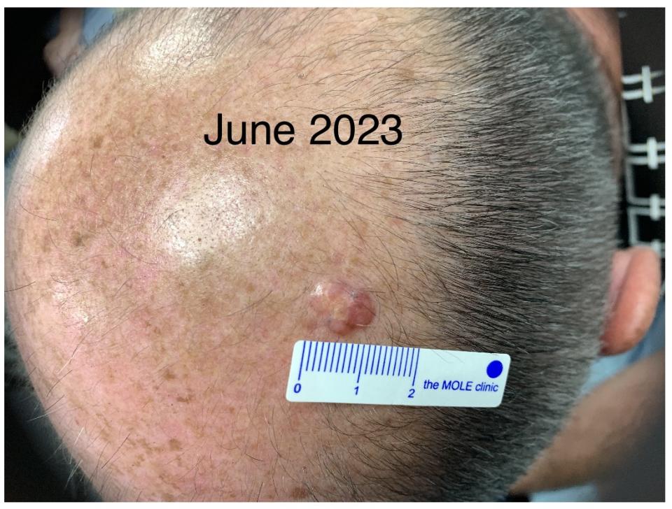 Young's melanoma on the top of his head, which he had removed last August. (PA)