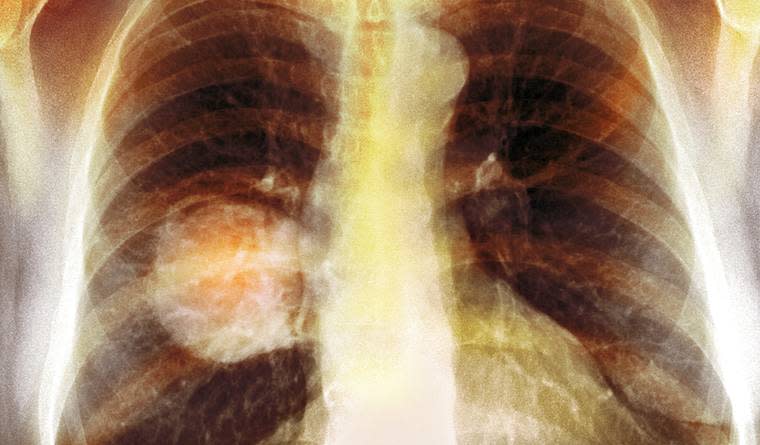 The Biggest Breakthrough Lung Cancer Medicine Can't Get Through the FDA