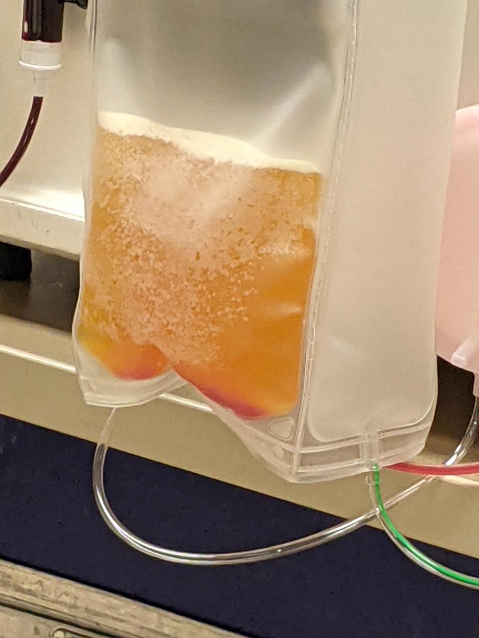 Orangey fluid in a transparent bag