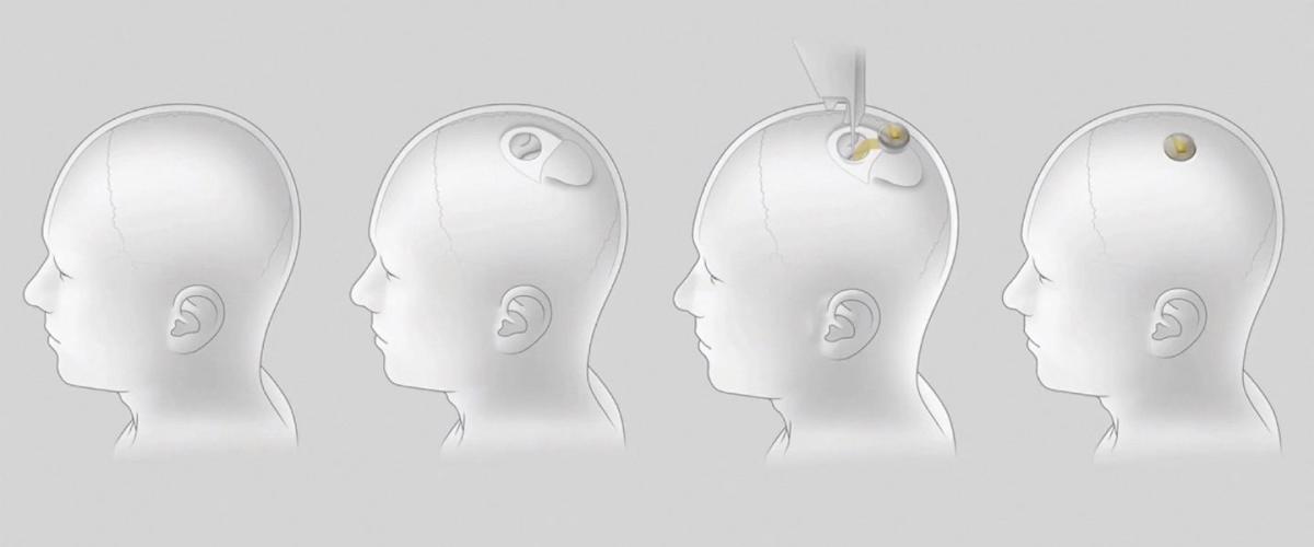 Implants Neuralink : Les dernières avancées et effets secondaires potentiels