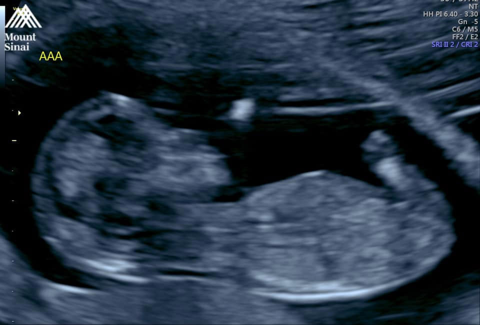 Kristin Diversi's ultrasound | Courtesy Kristin Diversi