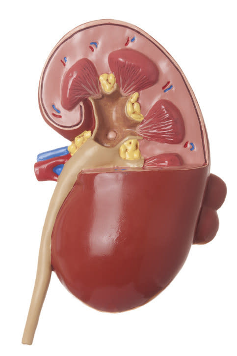 real human kidney stone