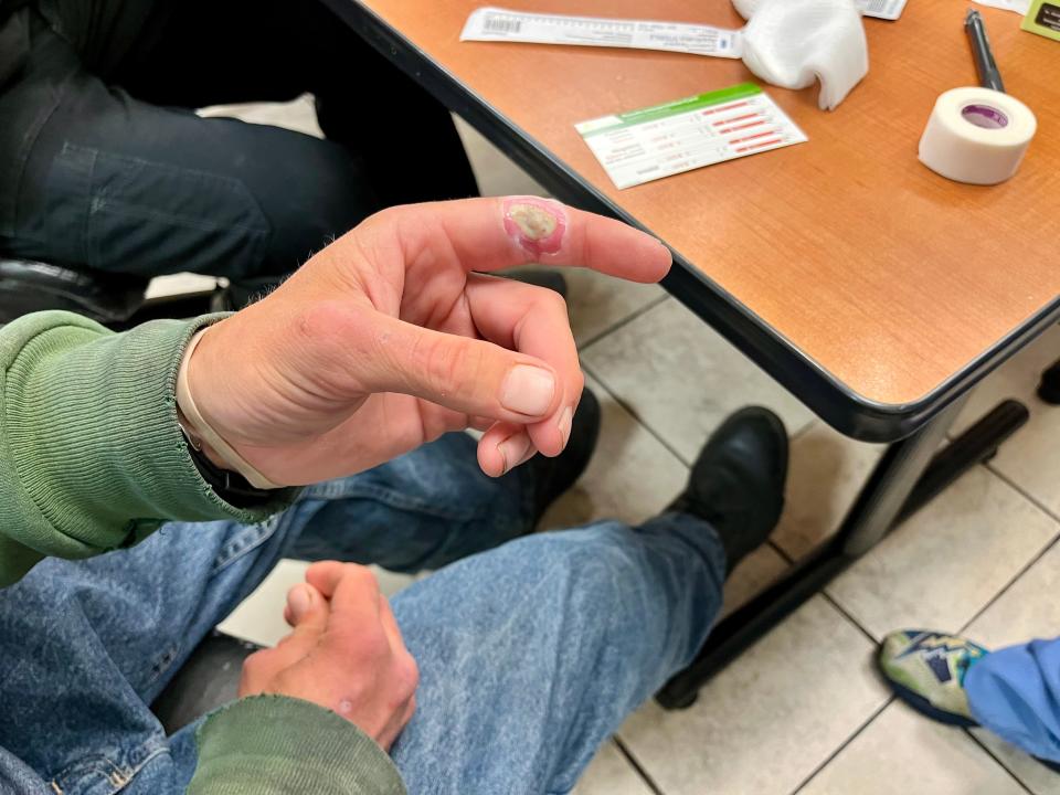 A xylazine wound on a man's hand at Brandywine Counseling & Community Services on Thursday, April 20, 2023. Xylazine, an animal tranquilizer, is being mixed with fentanyl. It causes horrific wounds on users' bodies.