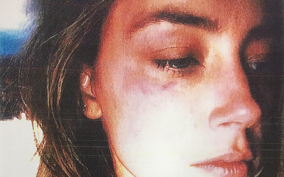 Amber Heard claims she suffered bruises - PA