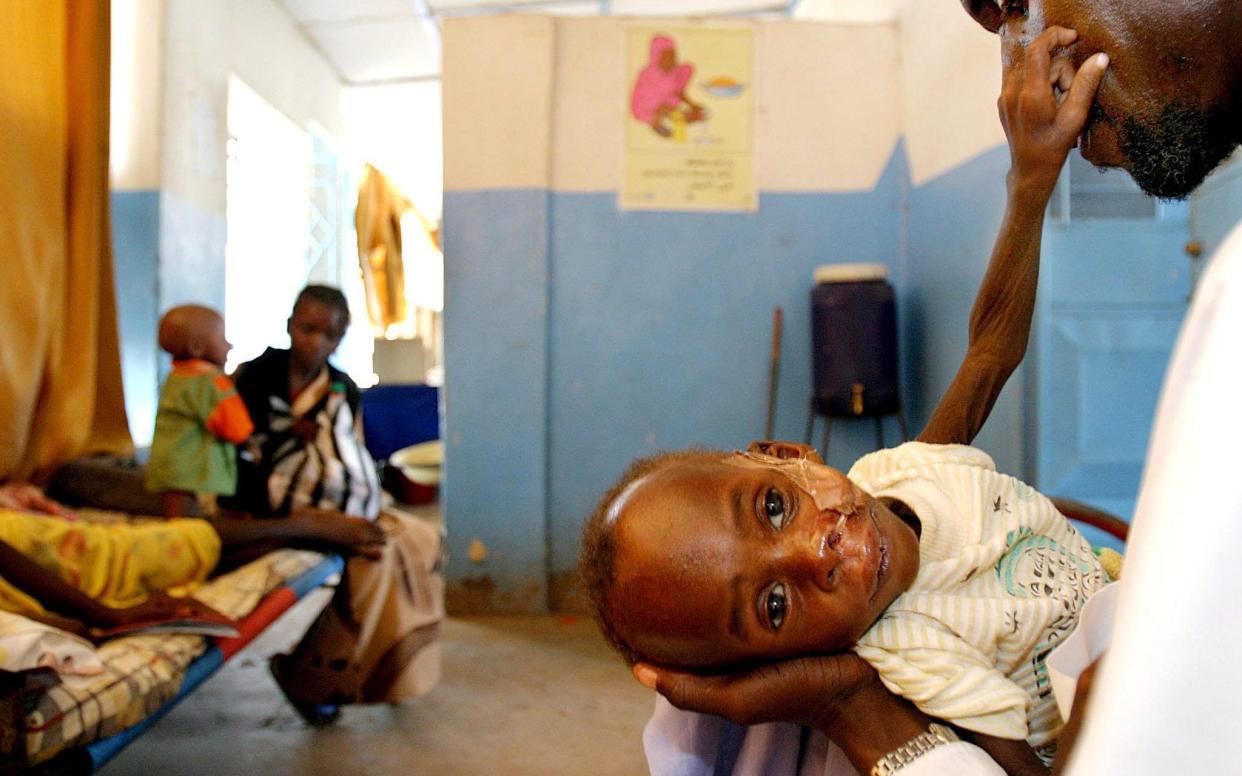 An 18-month-old boy suffering TB in Sudan - EPA/NIC BOTHMA