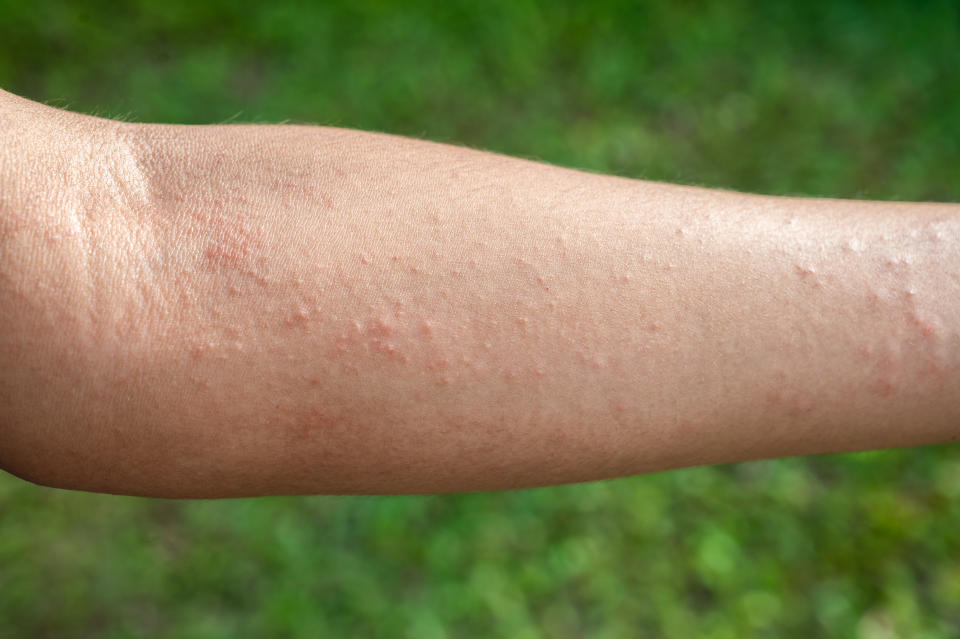 Little bumps appeared on the skin. Upon scratching, they became nasty, red patches. PHOTO: Getty Images