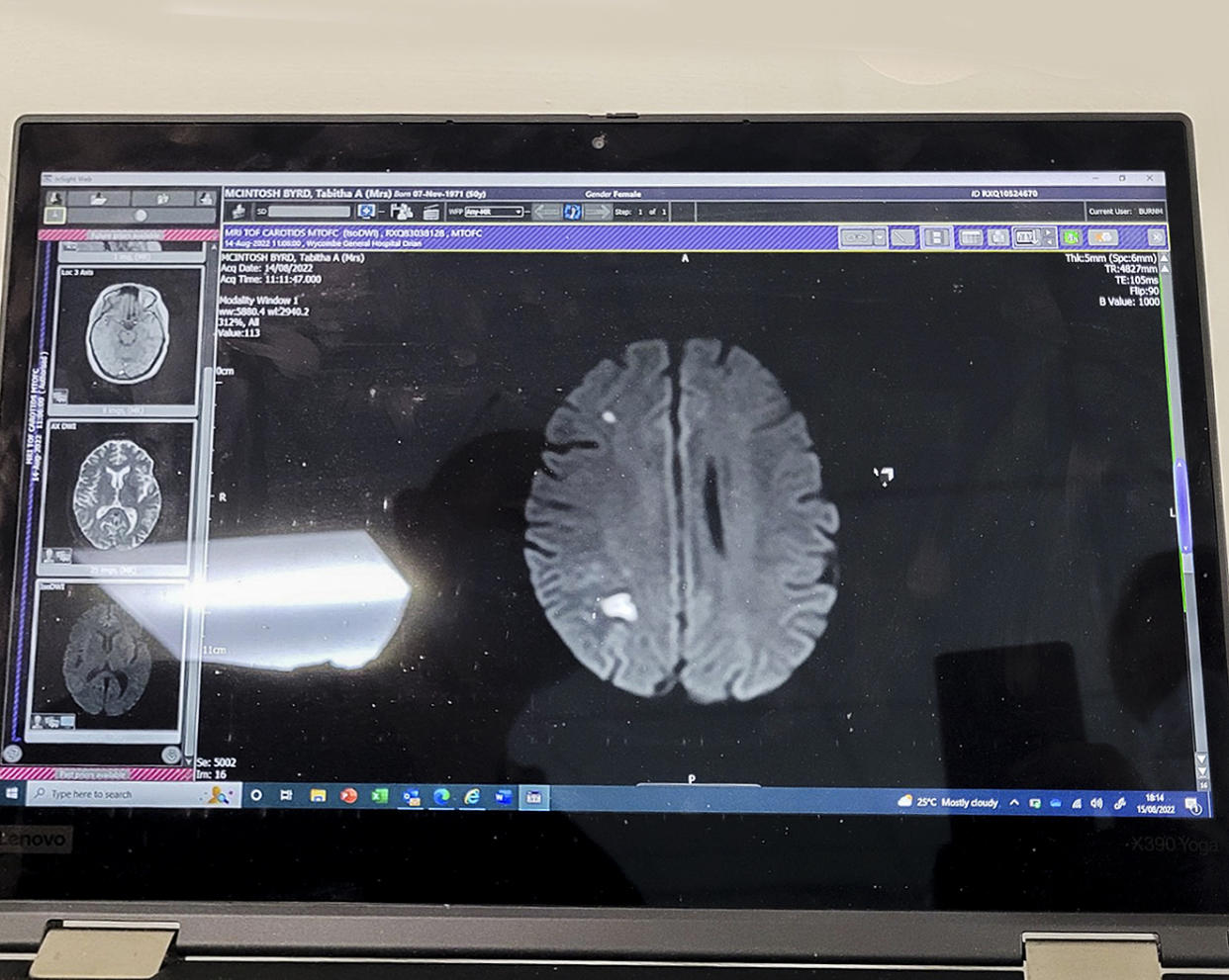 A scan of Tabitha McIntosh's brain after she thought perimenopause caused her constant headache, but it was a sign of a stroke. (Courtesy Tabitha McIntosh)