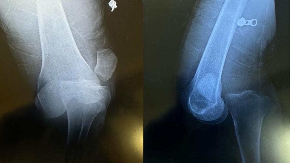 X-Ray scans of Durtschi's dislocated knee.<p>Courtesy Tim Durtschi</p>