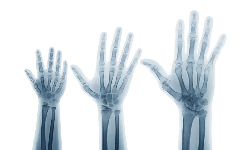 La imagen de rayos X de las manos y articulaciones de la muñeca izquierda (vista frontal) permite calcular la edad ósea. Suttha Burawonk/Shutterstock