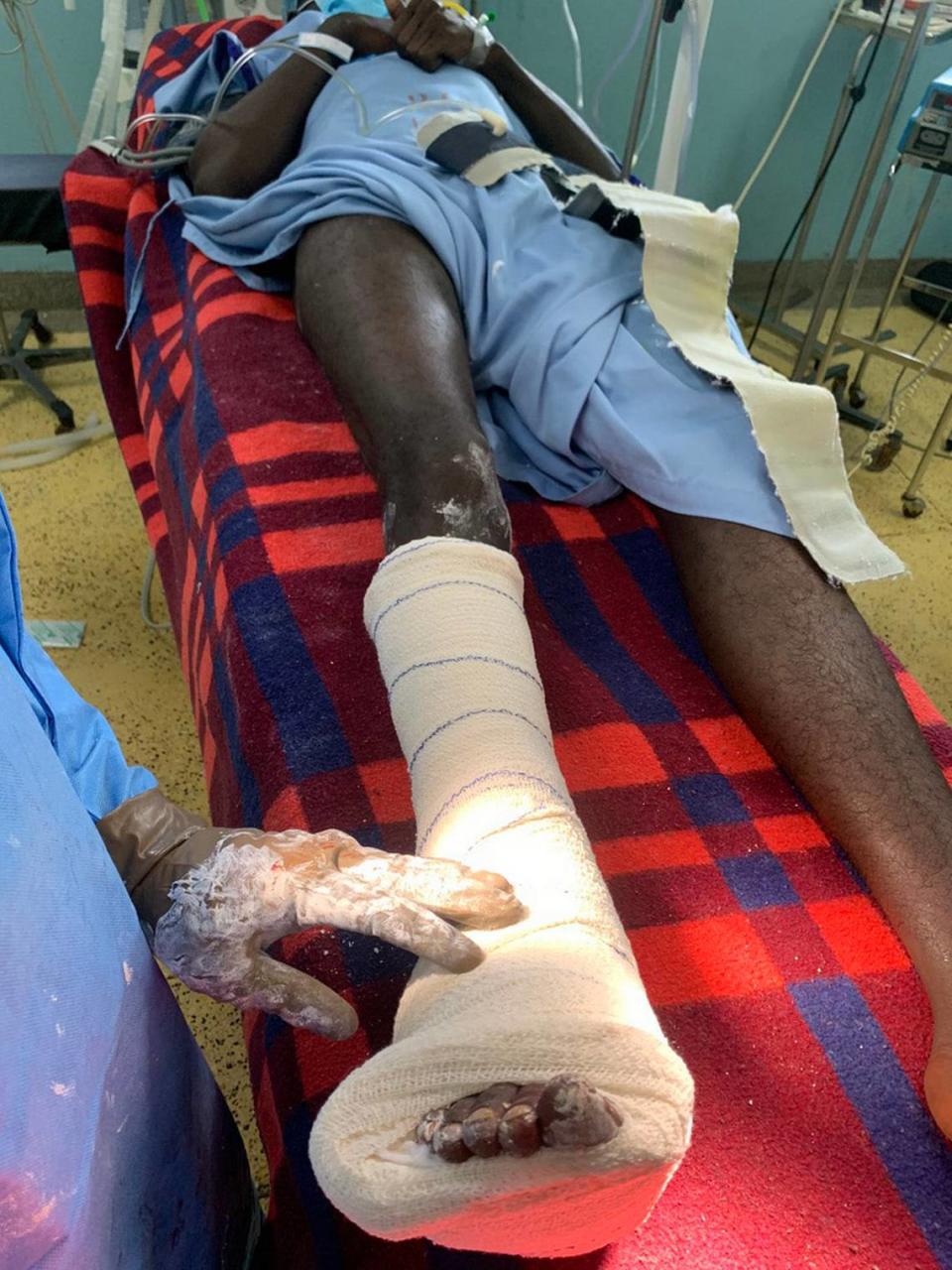 This photo shows a patient with clubfoot after surgery he received in Nairobi, Kenya through the Steps2Walk, Inc. program.