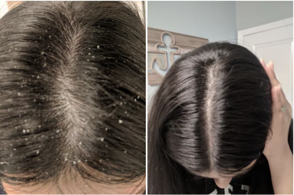 A reviewers scalp with a significant amount of flakes on the left, the same reviewer's scalp, but shiny and flake-free on the right