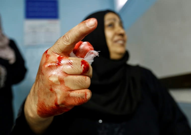 A Palestinian woman injured by Israeli air strikes gestures with her bloodied hand as she sits after receiving treatment at al-Shifa hospital in Gaza City on July 14, 2018